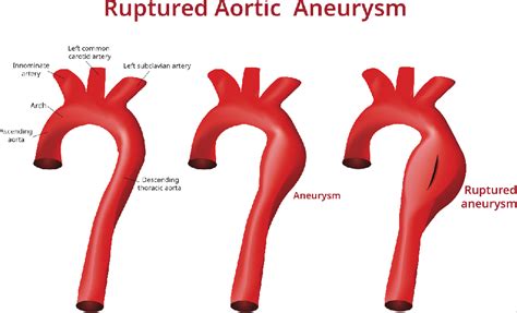aorta varicoasă